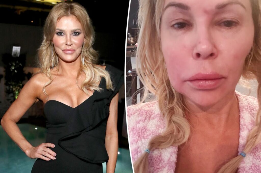 Brandi Glanville finally reveals cause of facial parasites