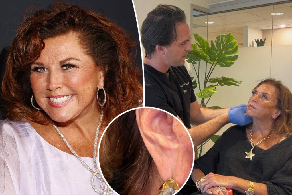 Abby Lee Miller shows off results of ‘amazing’ $1,000 ear rejuvenation surgery